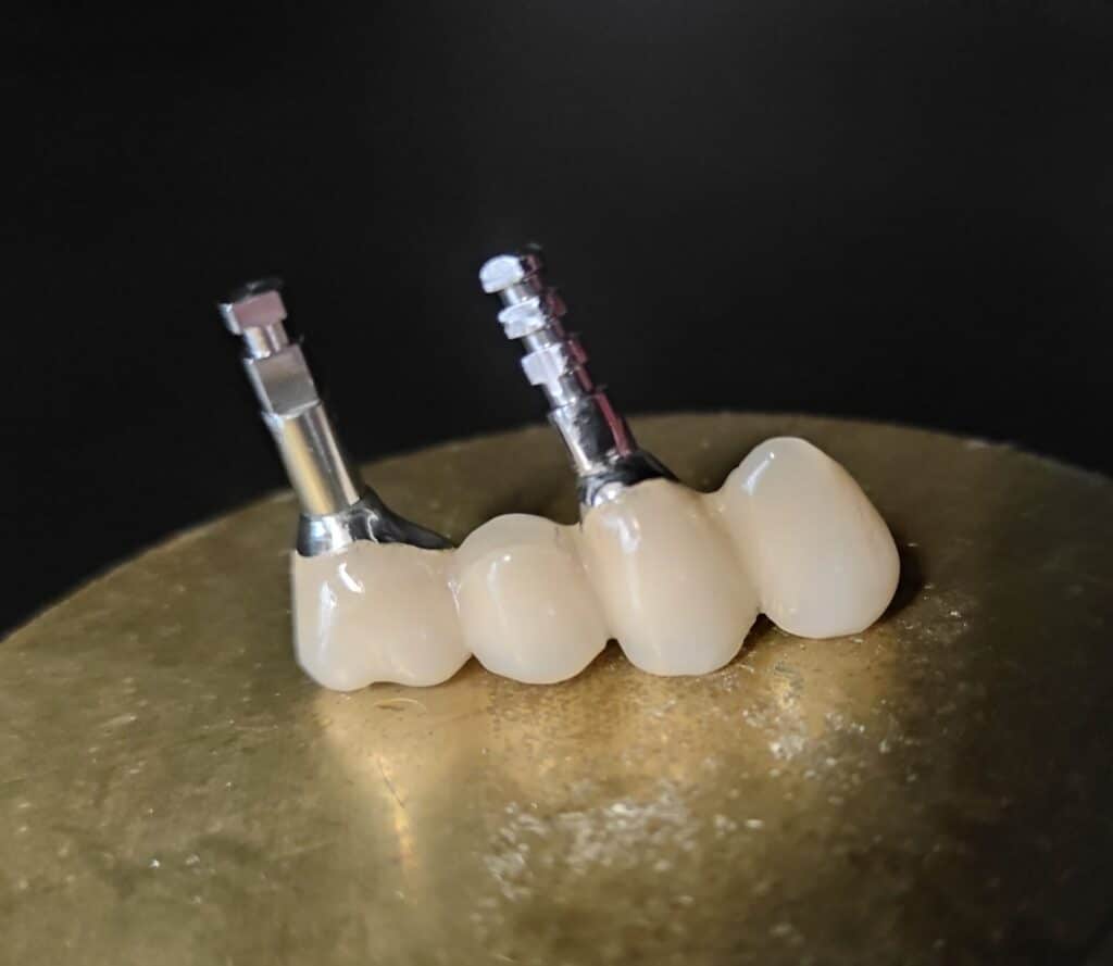 Ακίνητες οδοντικές προσθετικές αποκαταστάσεις