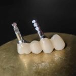 implants fixed restoration