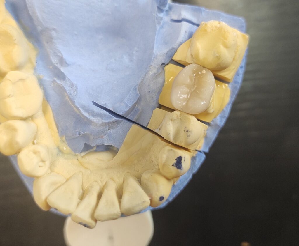 Ένθετα Inlays LightCuring