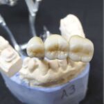 "Συνδυασμός δύναμης και ομορφιάς: Τα οφέλη της επιλογής αισθητικών μονολιθικών στεφάνων ζιρκονίας" Monolithic Zirconia